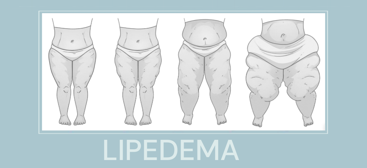 LIPEDEMA